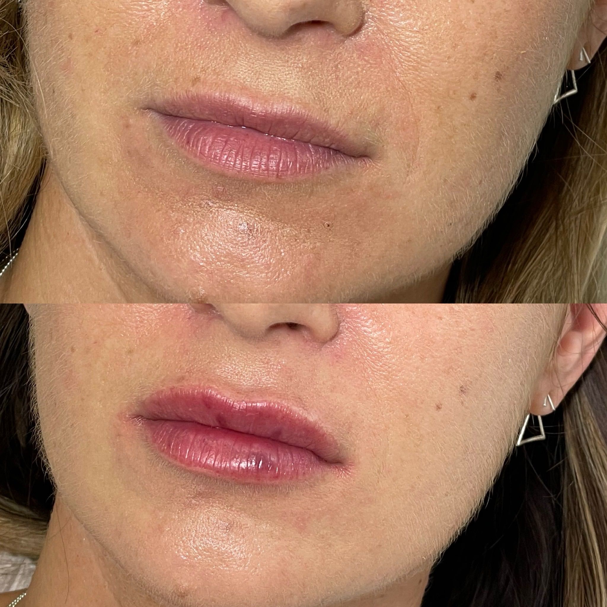 Lip Fillers, Botox, Dermal Fillers, Anti-Wrinkle Injections in Boston Manor W7